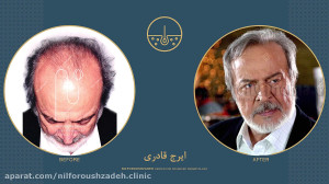 ایرج قادری قبل و بعد از کاشت م...