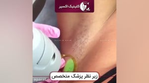لیزر موهای زائد بدن