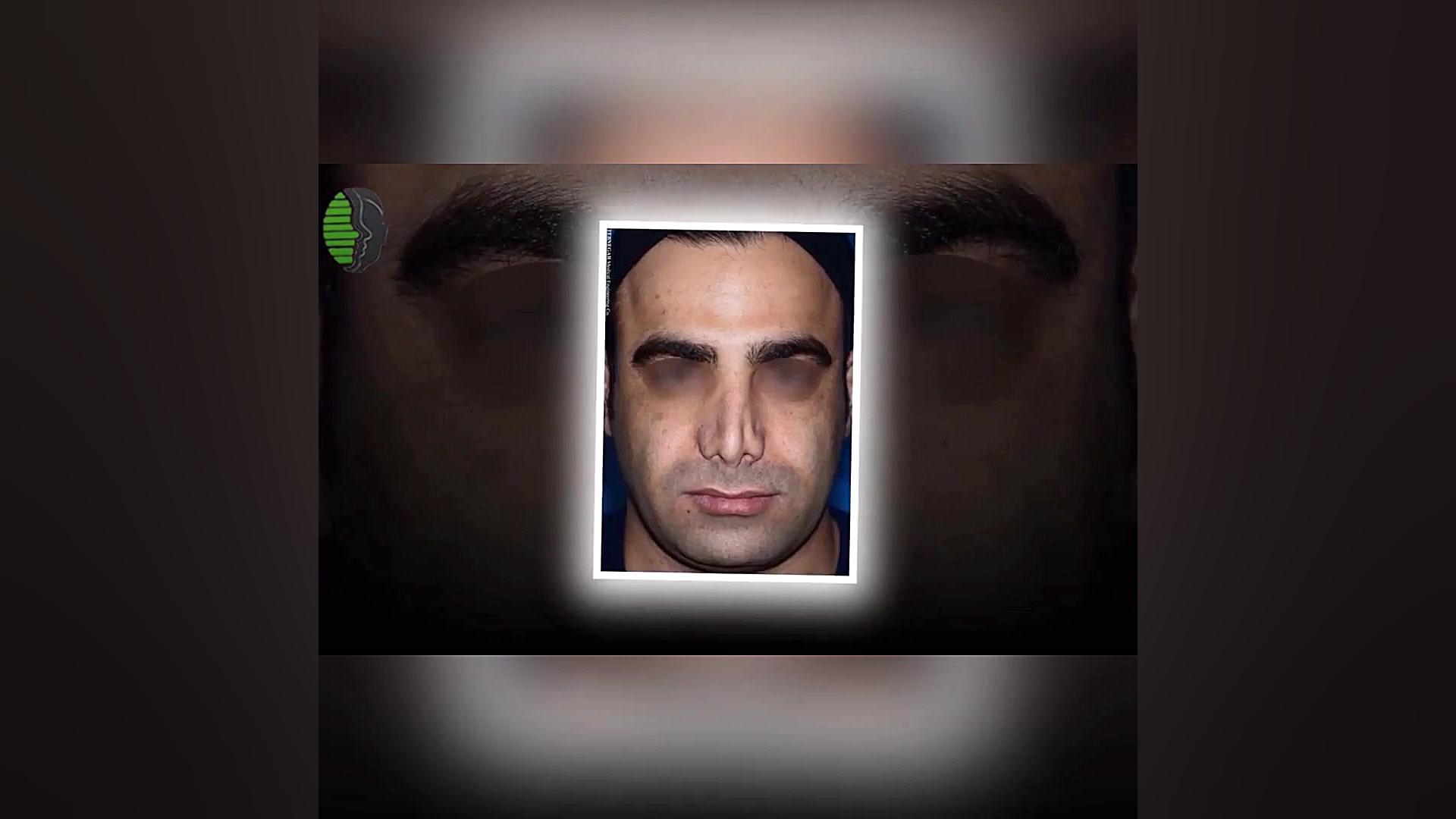 جراحی بینی ترمیمی با سابقه دو...