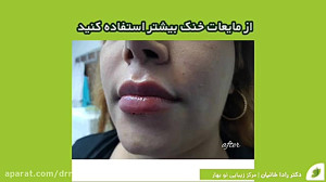 تزریق ژل لب و مراقبتهای بعد از...
