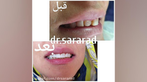 قبل و بعد درمان تعویض کامپوزیت...