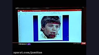 درمان ناهنجاری فک با ارتودنسی...