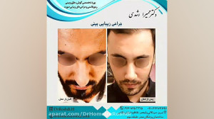 نمونه کار جراحی زیبایی بینی