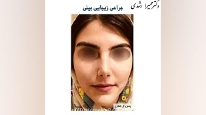 جراحی زیبایی بینی
