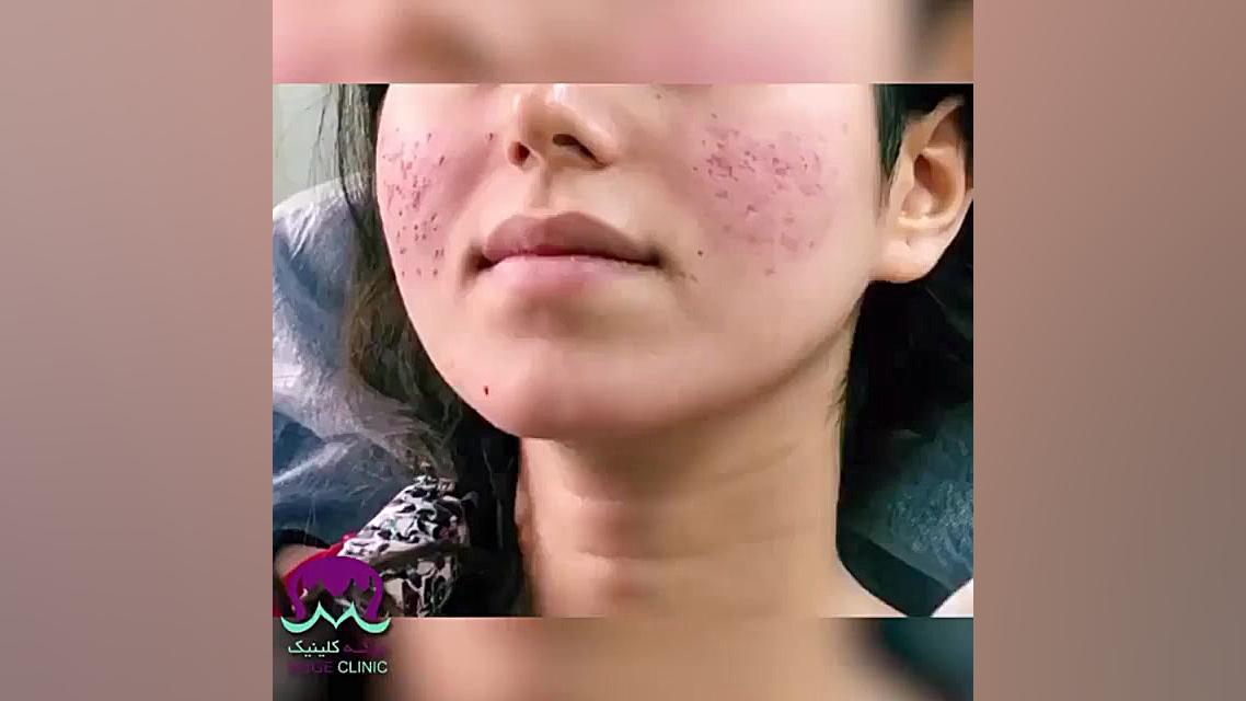 درمان جای جوش با پانچ موگه کلی...