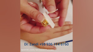 نازل اتصال دهنده فیبر اصلی لیز...