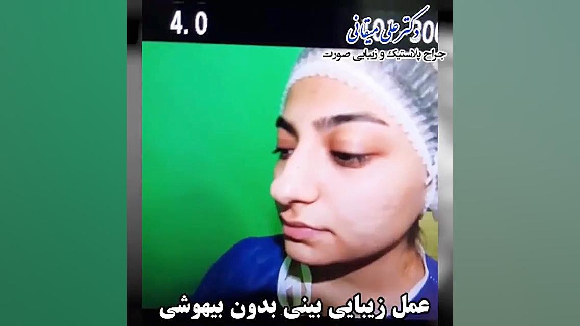 فیلم عمل زیبایی بینی بدون بیهو...