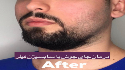 درمان جای جوش با سابسیژن فیلر...