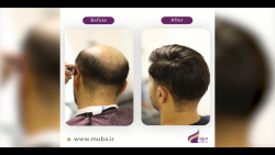 نصب پروتز مو موبا