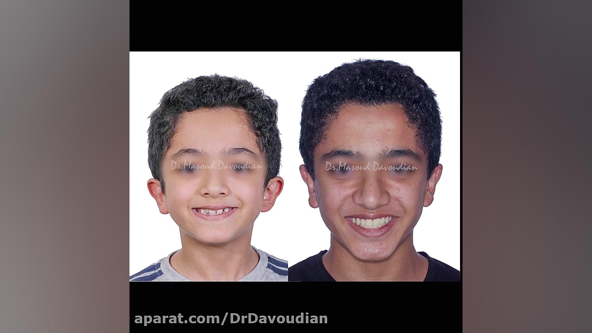 هدایت رشد فک بالا | دکتر داودی...