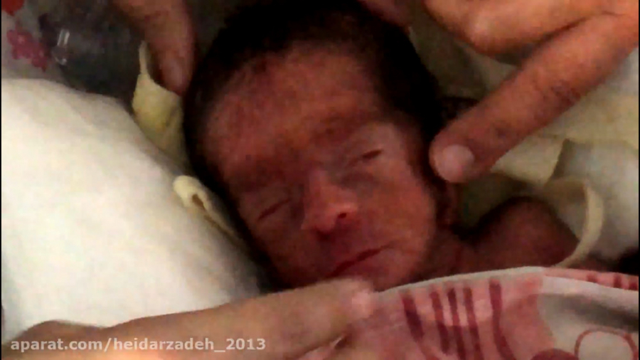 مراقبت پرستاری نوزادان تحت NCP...