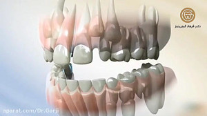 میدلاین به خط وسط قوس دندان ها...