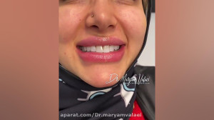 بهترین مرکز انجام کامپوزیت ونی...