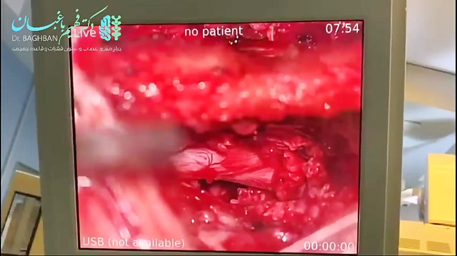 جراحی پارگی دیسک کمر در آقای 1...