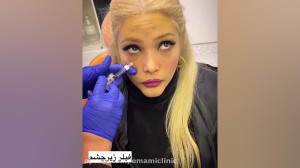 تزریق ژل زیر چشم