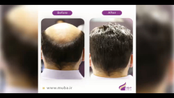 نصب پروتز مو موبا