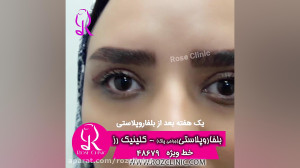فیلم کاشت ابرو | کلینیک رز | 0...