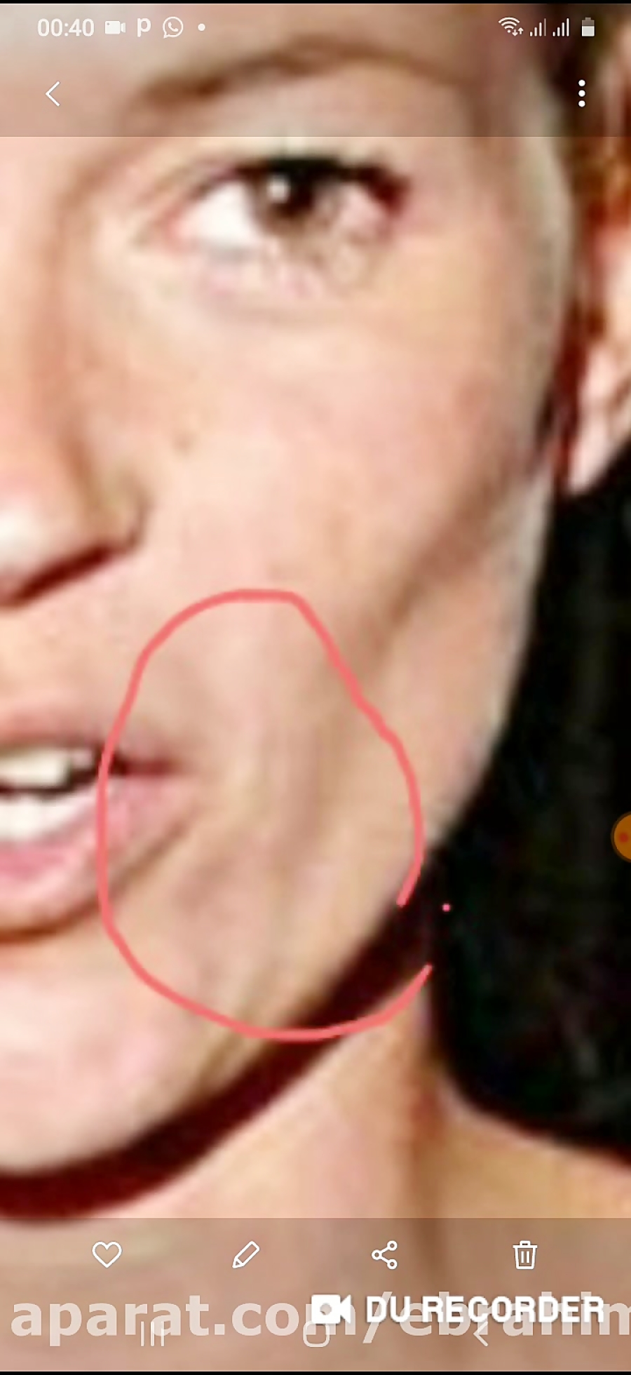 تزریق فیلر در افراد لاغر www.e...