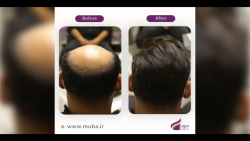 پروتز مو به روش موبا