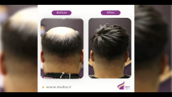 پروتز مو تحولی بزرگ در ترمیم م...