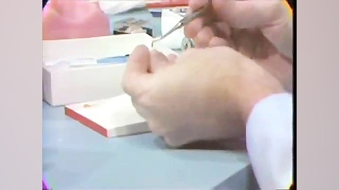 ساخت روکش موقت دندان با روکش پ...