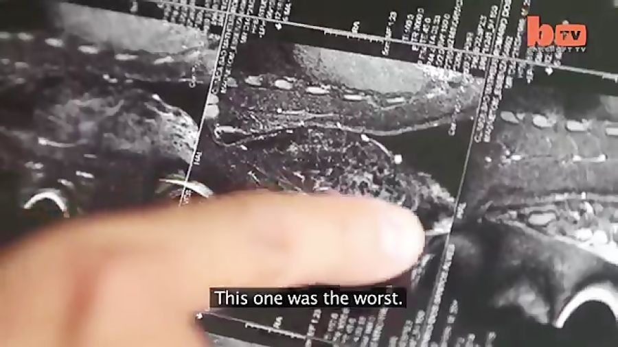 تزریقات عضلانی با آمپول