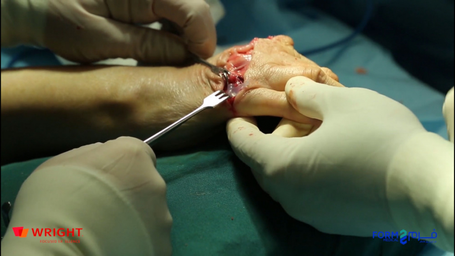 Swanson Finger Joint Implant پ...