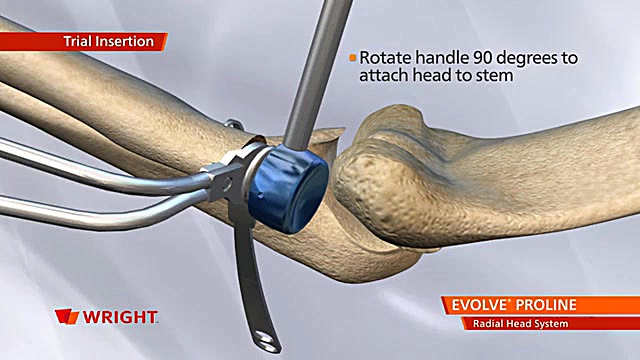 Redial Head Implant