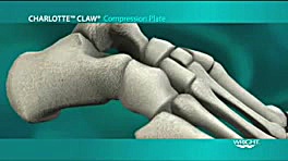 Claw II compression plating Sy...