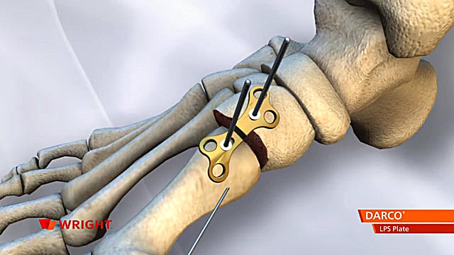 Darco MRS Locking plate