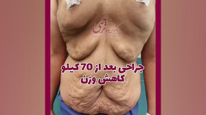 فیلم جراحی پلاستیک بعد از 70 ک...