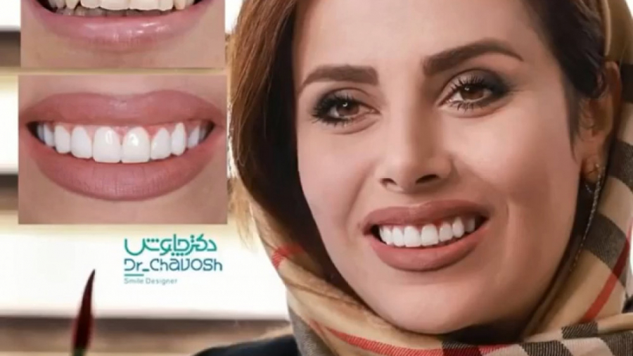 کامپوزیت دندان بعد از یکسال