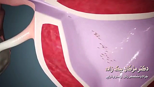 فیلم حاملگی خارج از رحم
