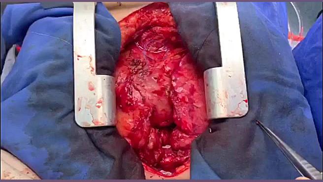 جراحی تعویض دریچه قلب