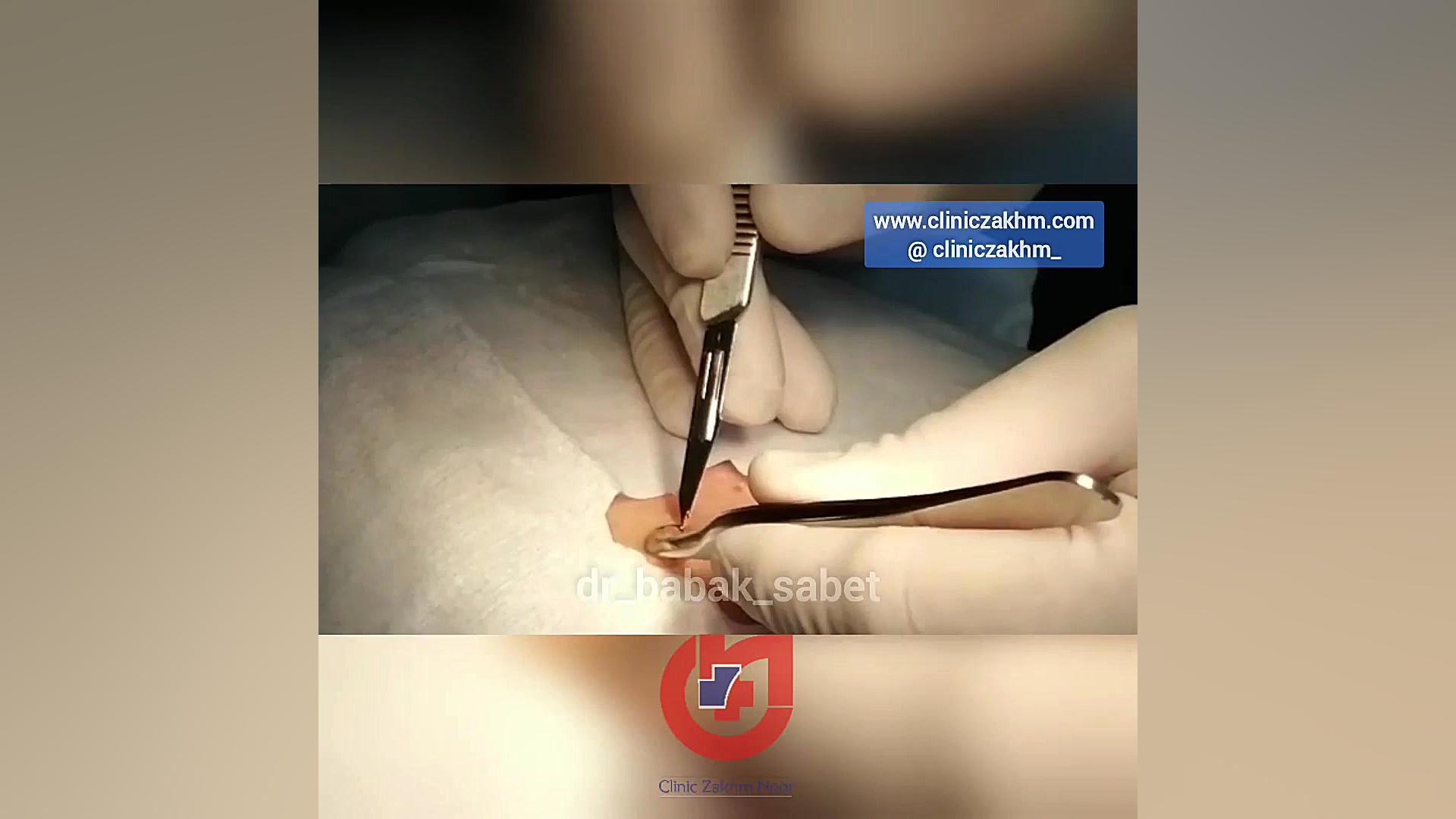 جراحی خال صورت