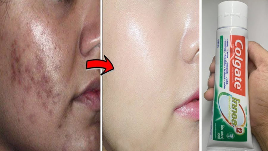 حذف جای جوش صورت با گوجه و خمی...