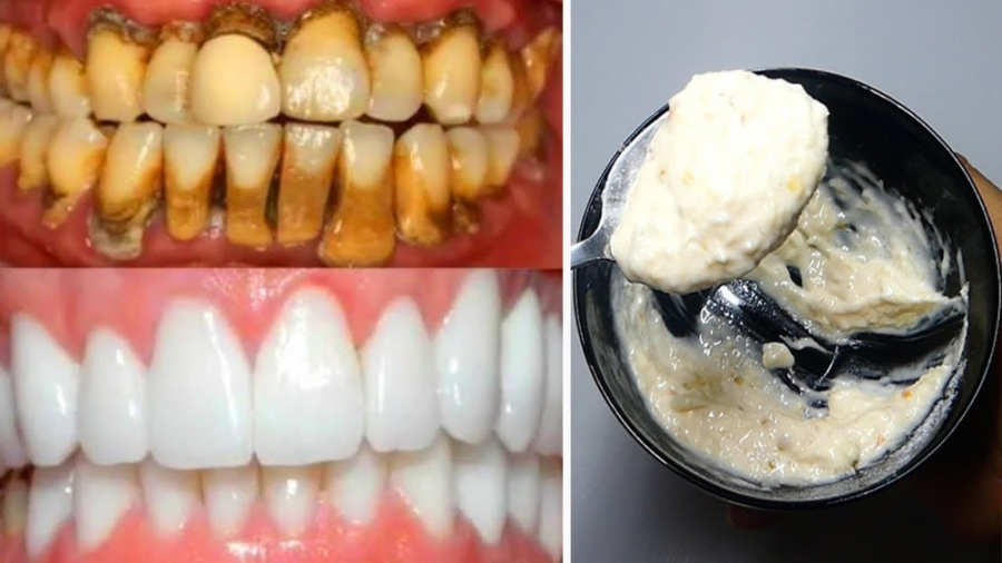 سفید کننده قوی دندان های زرد ب...