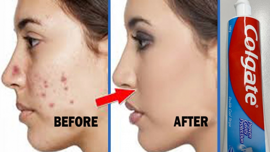 چگونه جوش ها را یک شبه از بین...