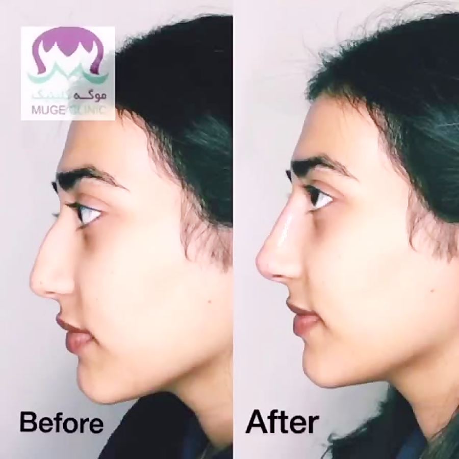 فرمدهی بینی با تزریق فیلر بدون...