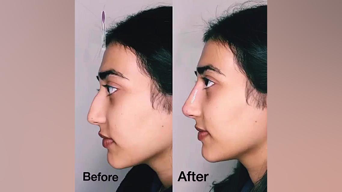 فرمدهی بینی با تزریق فیلر بدون...