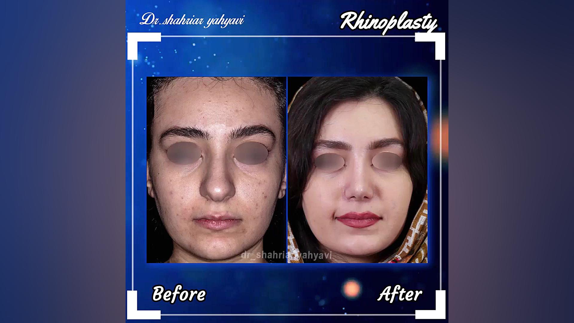 نمونه کار جراحی بینی