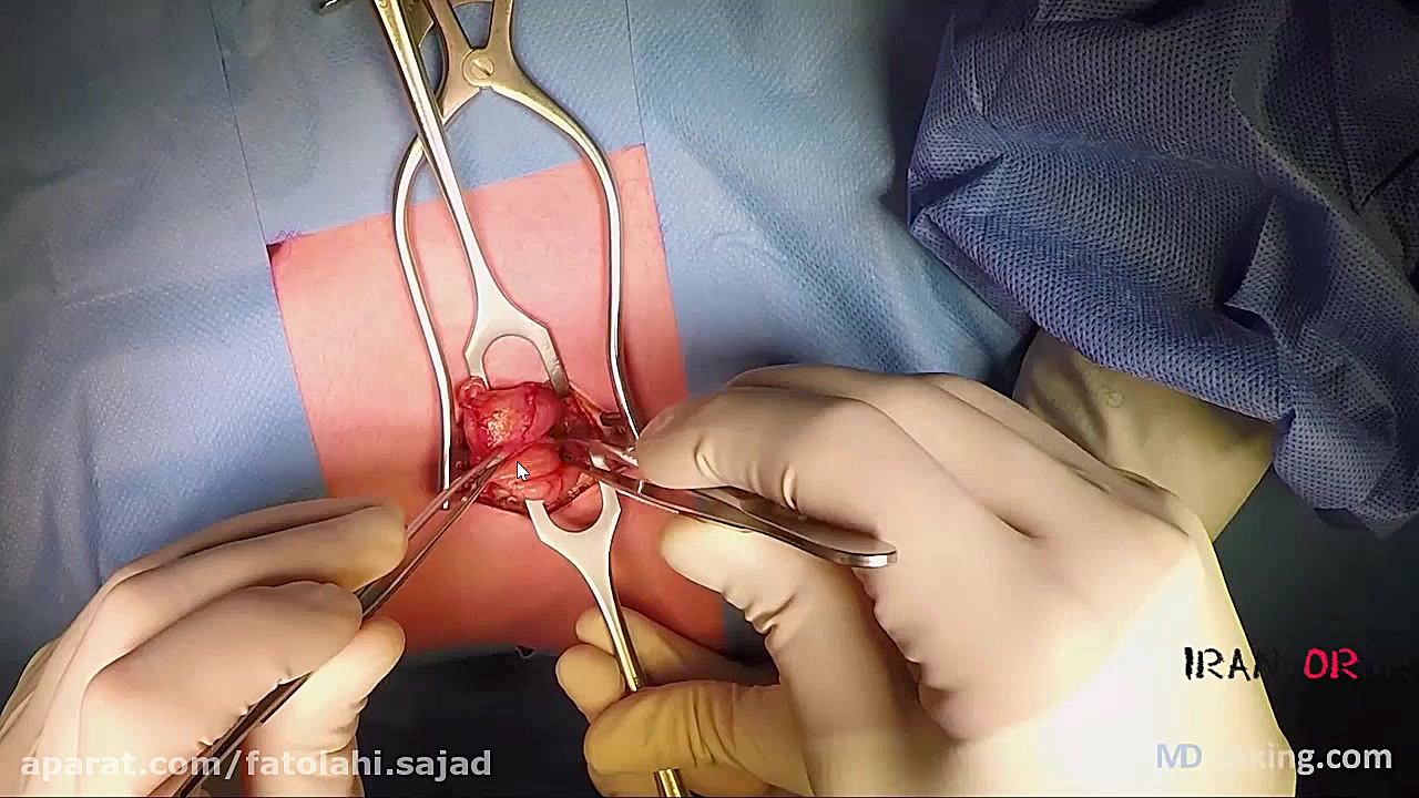 آموزش عمل جراحی آپاندکتومی (آپ...