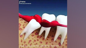 فیلم جراحی دندان عقل