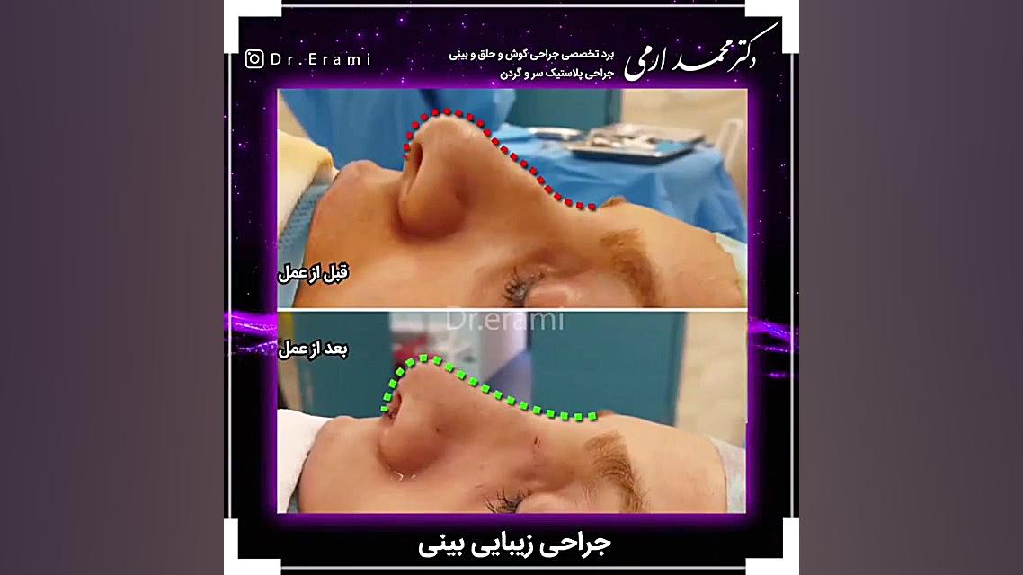 جراحی زیبایی بینی | متخصص گوش...
