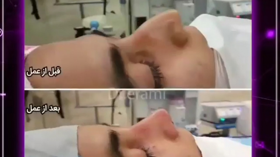 جراحی بینی توسط دکتر محمد ارمی