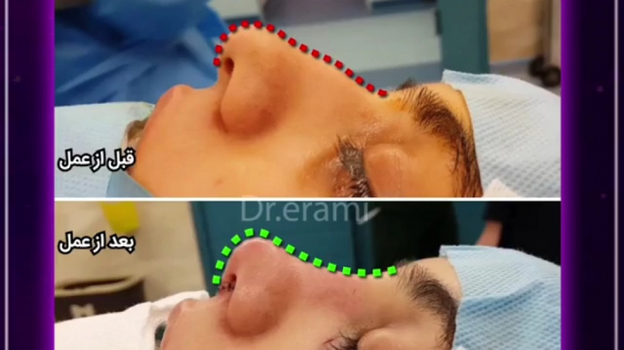 قبل و بعد جراحی بینی