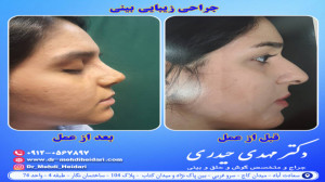 جراحی زیبایی بینی