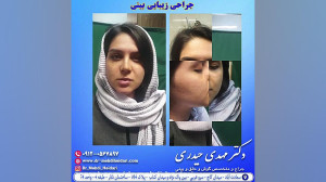 جراحی زیبایی بینی