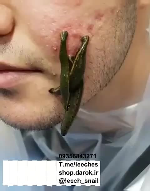 جوش صورت درمان