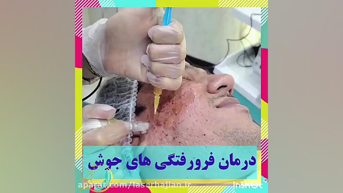 درمان فرورفتگی های جوش